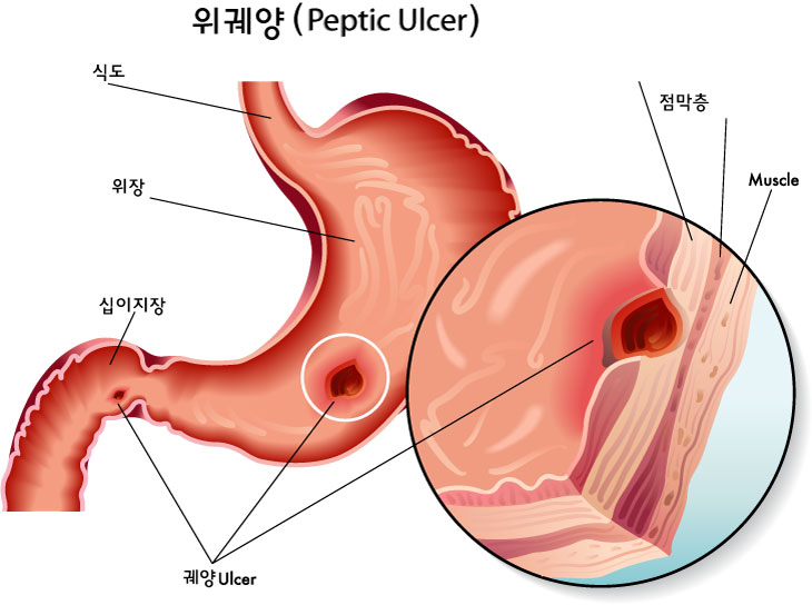 Peptic.Ulcer.jpg