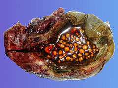 GALLSTONE.jpg